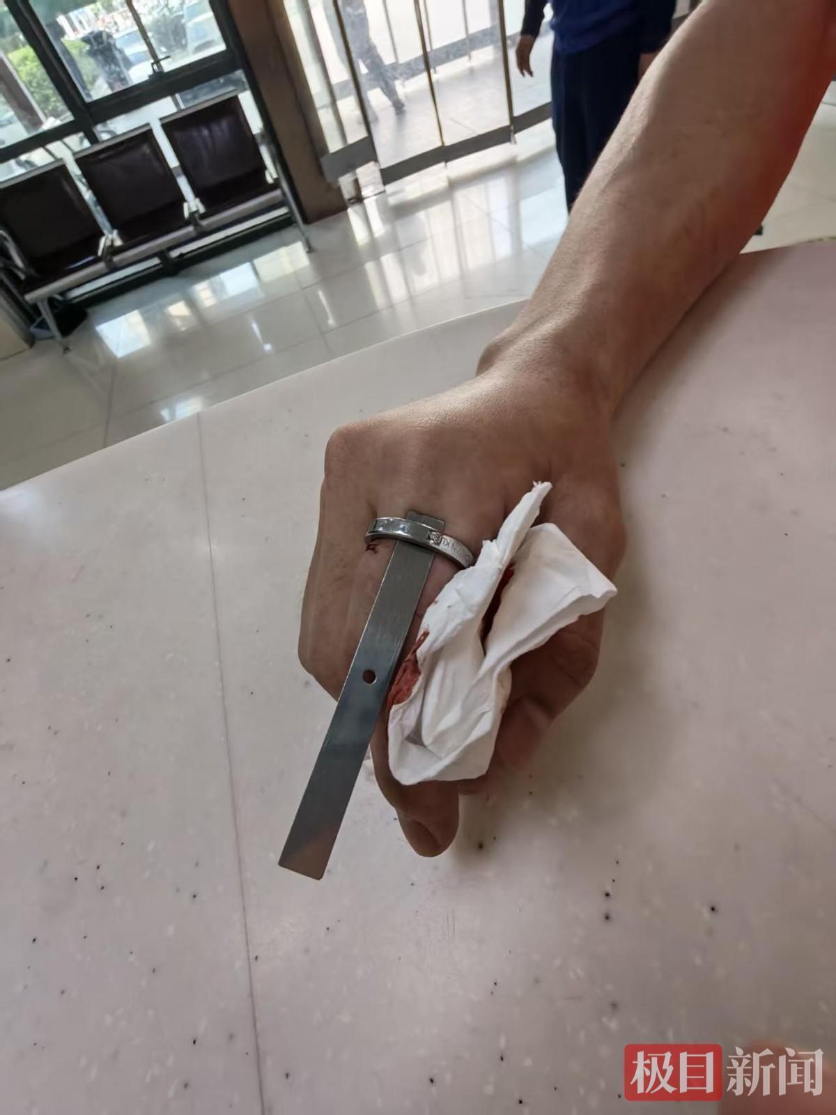  戒指嵌顿危机：消防与医学联动救援的技术复盘与肢体急救指南 健康养生